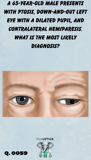 a drawing of a patient with down-and-out palsy of the eye