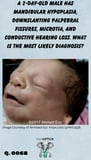 a neonate with mandibular hypoplasia, downslanting palpebral fissures, and microtia