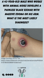 a black eschar with edema and redness on the upper inner arm of a patient