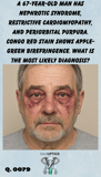 a middle aged caucasian male with bilateral periorbital purpura