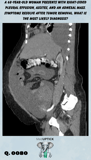 a sagital CT scan image demonstrating abdominal ascites