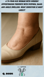 an ankle close-up of lower limb edema