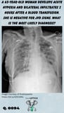 a chest x-ray of a woman with bilateral infiltrates
