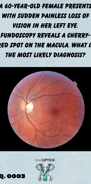 fundoscopy image of a cherry red spot
