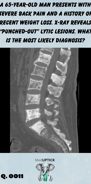 MRI imaging showing punch our lesions of the tailbone of the spine