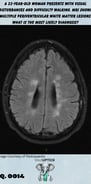 brain CT scan with multiple periventricular white matter lesion