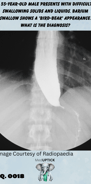 a gastrograffin image with a birds beak of an esophagus
