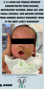 a female neonate with facial diplegia