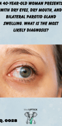 a close-up of a female's eye demonstrating redness and irritation of the sclera