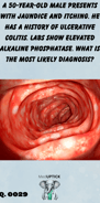 colonoscopy view demonstrating ulcerative colitis