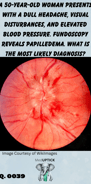 a close up fundoscopy image demonstrating papilledema