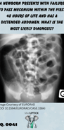 an x-ray image of distended small intestines