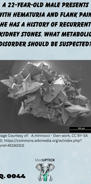 3-D spectrometry of a kidney stone