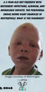 a young African American boy with albinism