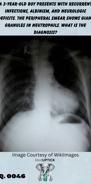 an x-ray of a child with a boot-shaped heart