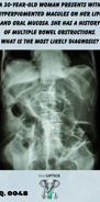 an abdominal x-ray demonstrating bowel obstruction