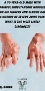 a close up of an elderly patients hands with disfigurement and joint masses