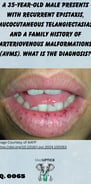 a close up image of a male's lips showing mucocutaneous telangiectasias