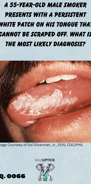 a male with a white lesion on the lateral side of his tongue