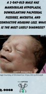 a neonate with mandibular hypoplasia, downslanting palpebral fissures, and microtia