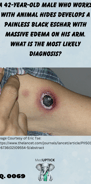 a black eschar with edema and redness on the upper inner arm of a patient