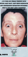 close up of a woman's face who has vertical eye palsy