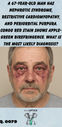 a middle aged caucasian male with bilateral periorbital purpura