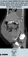 a sagital CT scan image demonstrating abdominal ascites