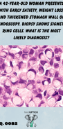 a histology slide showing signet ring cells
