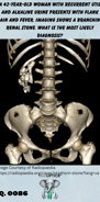 a 3-D image of a skeleton and a calcified kidney stone