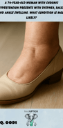 an ankle close-up of lower limb edema