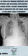 a chest x-ray of a woman with bilateral infiltrates