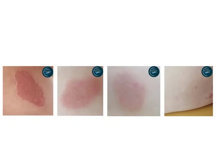 Eczéma
