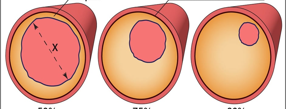 Myocardial Insulin Resistance and Subclinical Atherosclerosis in Metabolic Syndrome Phenotypes