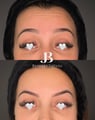 antes e depois botox