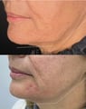 antes e depois harmonização facial