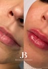 antes e depois preenchimento labial