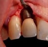 péri-implantite infection implant dentaire hygiene-precision.com