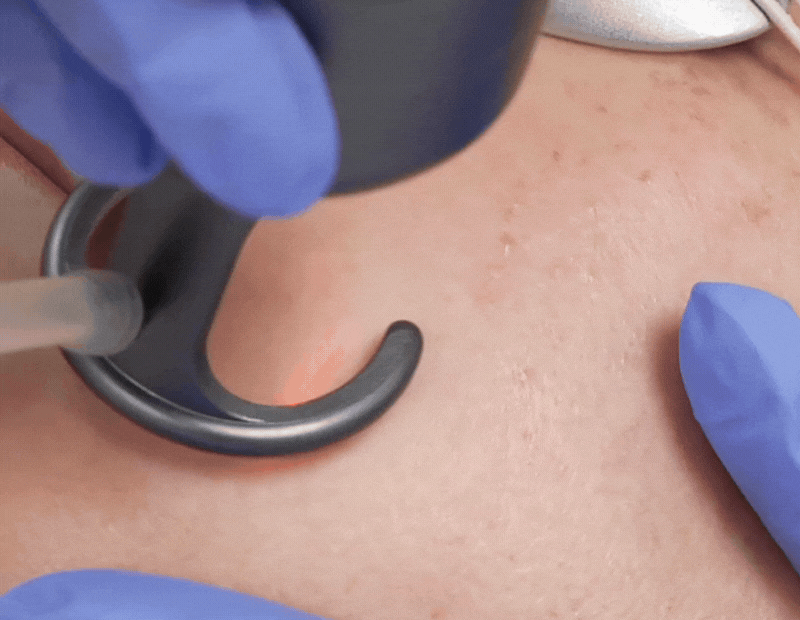 close up of fractional co2 laser done on skin