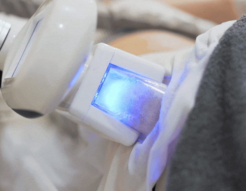 gif demonstrating coolsculpting process on patient