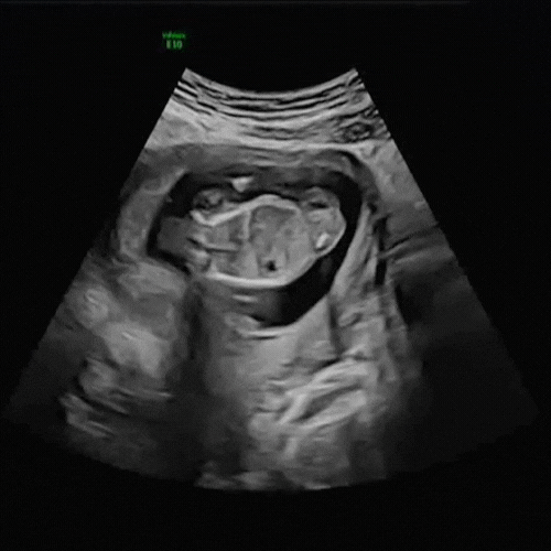 Ultrasound Scan