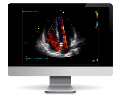 Echocardiogram
